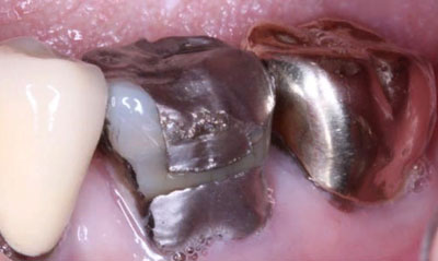 Вкладка на зуб из стали